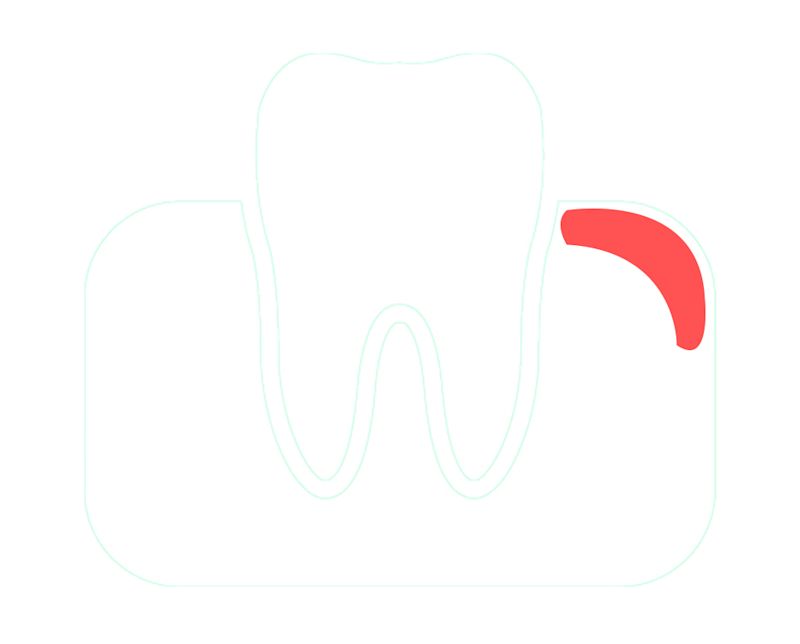 Gum Disease