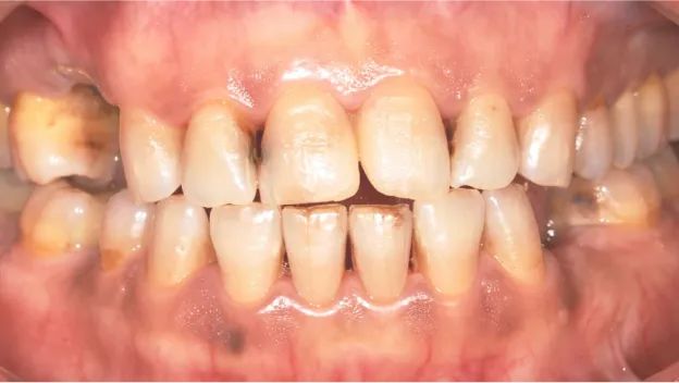 Close-up image of a tooth with missing sections, emphasizing presence of stain on teeths