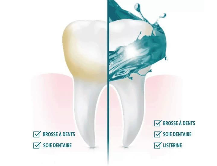 Image graphique d'une dent montrant le résultat de l'emploi du rince-bouche, de la brosse à dents et de la soie dentraire sur une moitié de la dent par rapport à l'emploi de la brosse à dents et de la soie dentaire seules sur l'autre moitié de la dent.