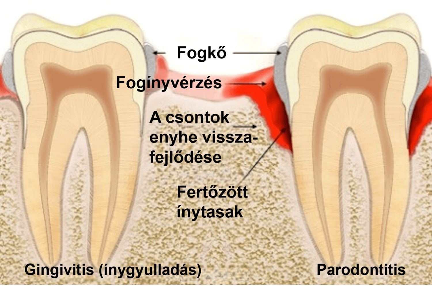 gingivitis (ínygyulladás) és parodontitis összehasonlítása. A parodontózis fogínyvérzéssel, a csontok enyhe visszafejlődésével és fertőzött ínytasakkal járhat.