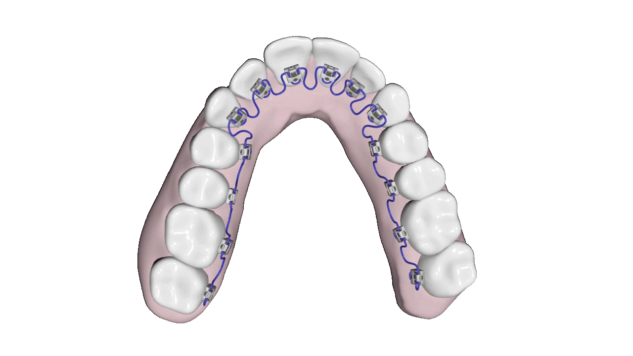 Animation of Breezy Braces inside a mouth