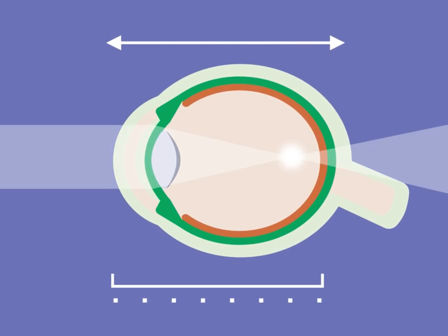 Myopia (Short-sightedness) – Symptoms, Causes and Treatment | Specsavers UK