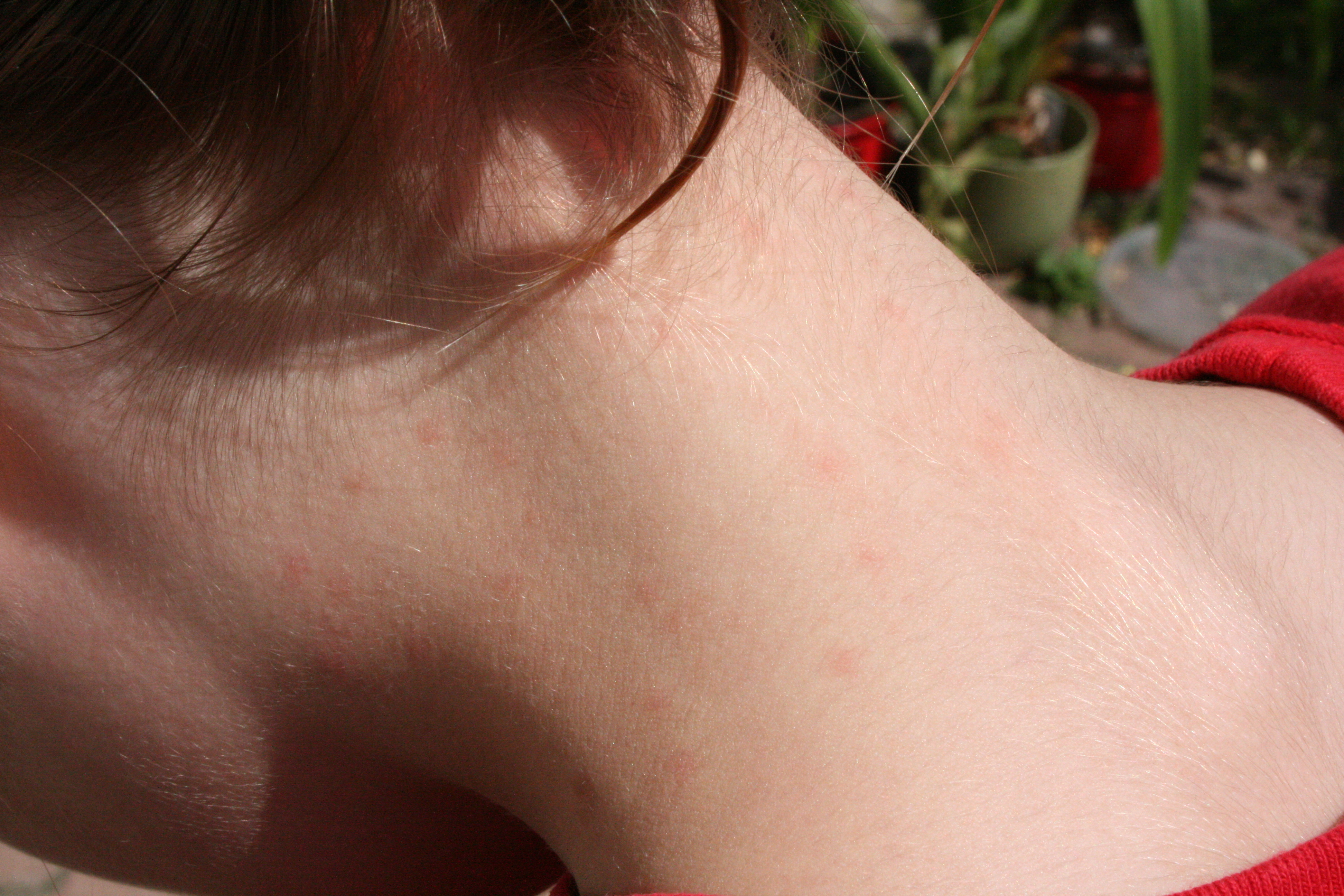 Nacken eines Mädchens mit roten Punkte, die typisch sind für einen Kopflausbefall