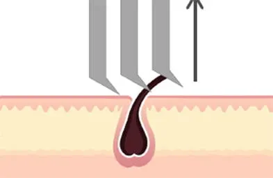 Diagram showing multiple razor blades cutting and pulling hair below skin surface