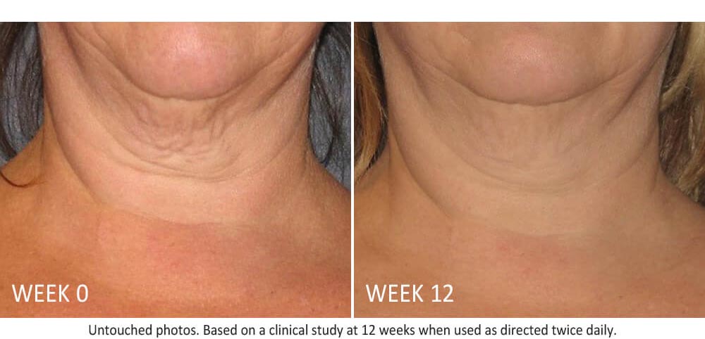 skin-active-triple-firming-neck-results