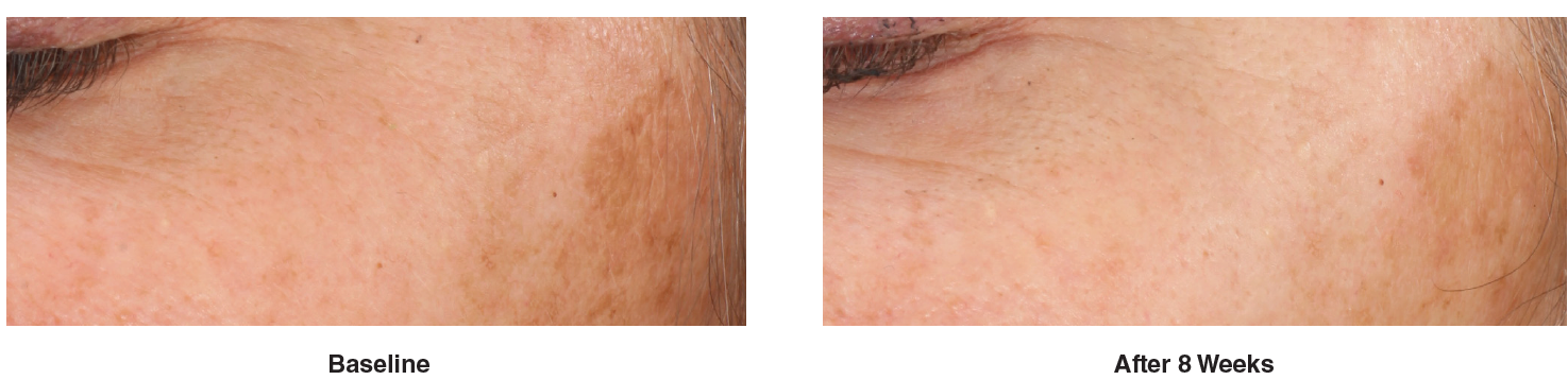 dark spot corrector before after