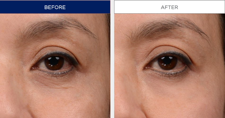 1 - eye cream before after