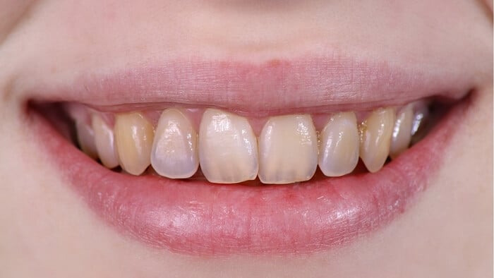 https://www.listerine.com.au/sites/listerine_au/files/3-1-4-sign-no-2-yellowish-teeth-03-0.jpg