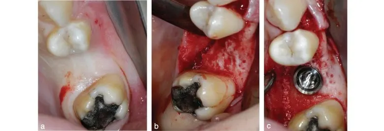 Incisions crestale et vestibulaire