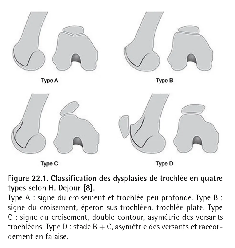 Figure 22.1 Quatre types de dysplasies sont définies