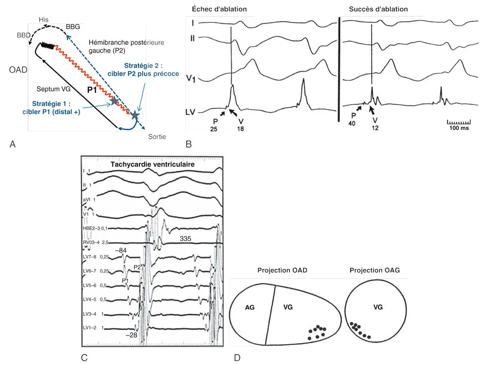 Ablation des tachycardies ventriculaires