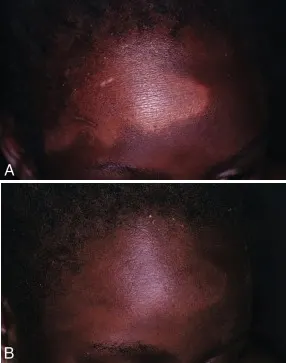 Fig. 9.3. Eczématides hypochromiantes -  Avant (A) et après (B) traitement.