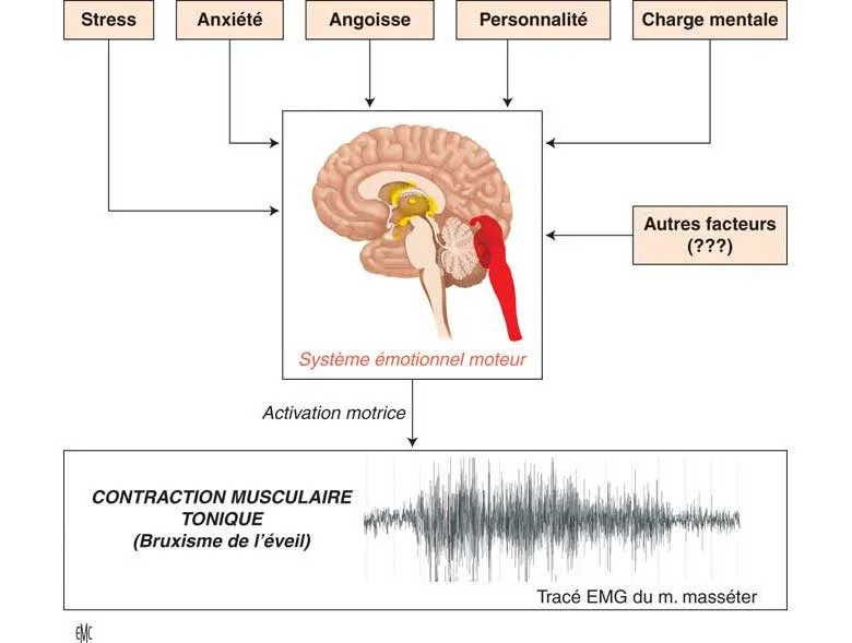 Schéma représentant la physiopathologie du bruxisme de l'éveil