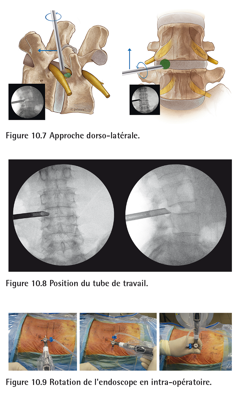 Technique endoscopique hernies discales