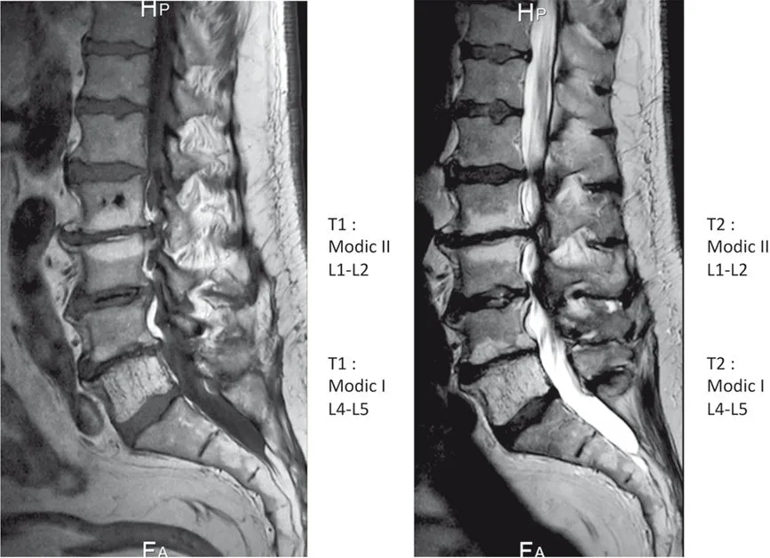 Modifications Modic de types 1 et 2 visible à l’IRM en pondération T1 et T2.