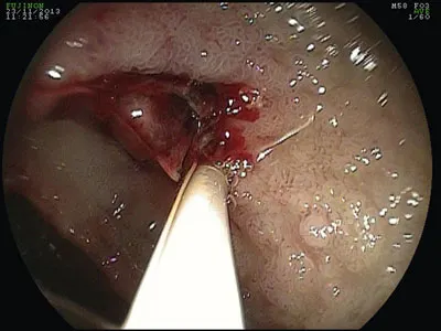 Figure 6.4 Sclérose endoscopique d-un ulcère du bulbe hémorragique.