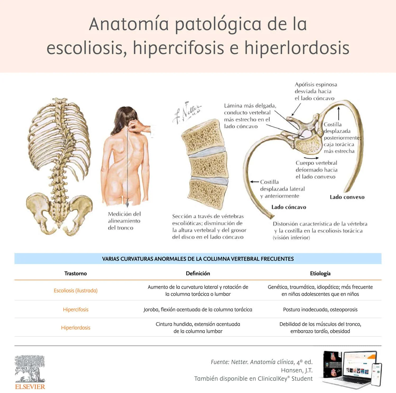 Infografia escoliosis hipercifosis e hiperlordosis