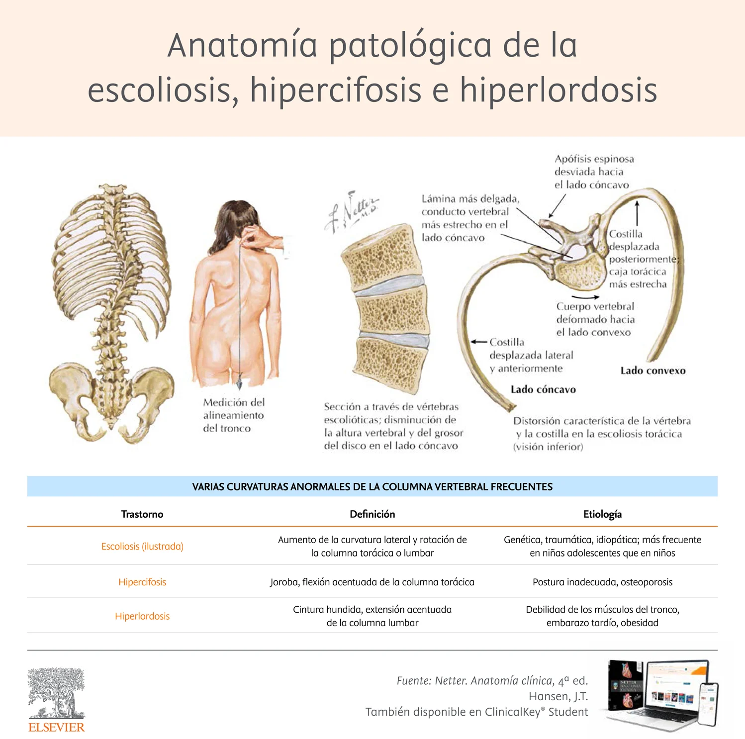 Anatomía patológica de la escoliosis, hipercifosis e hiperlordosis