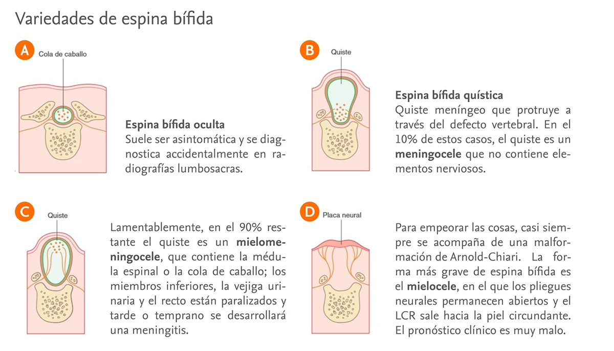 Espina Bifida Tipos