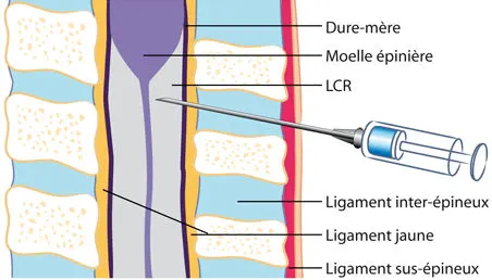 Rachianesthésie : injection dans l'espace du LCR.