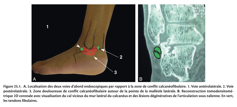 Traitement endoscopique du conflit calcan ofibulaire