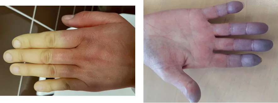 Phenomène de Raynaud : phase de pâleur cutanée (ou syncopal) et phase cyanique (ou asphyxique).