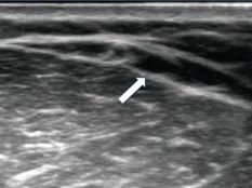 Figure 6.7. Hypoplasie de la veine céphalique au bras (flèche). Coupe transversale. 