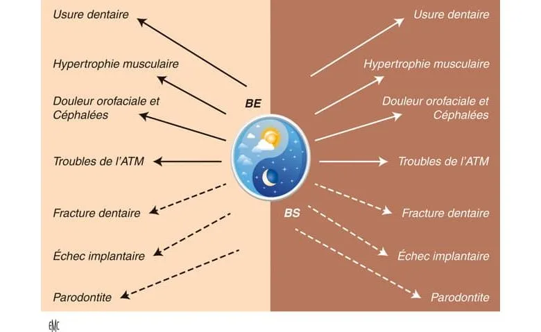 Les conséquences possibles du bruxisme du sommeil et de l'éveil