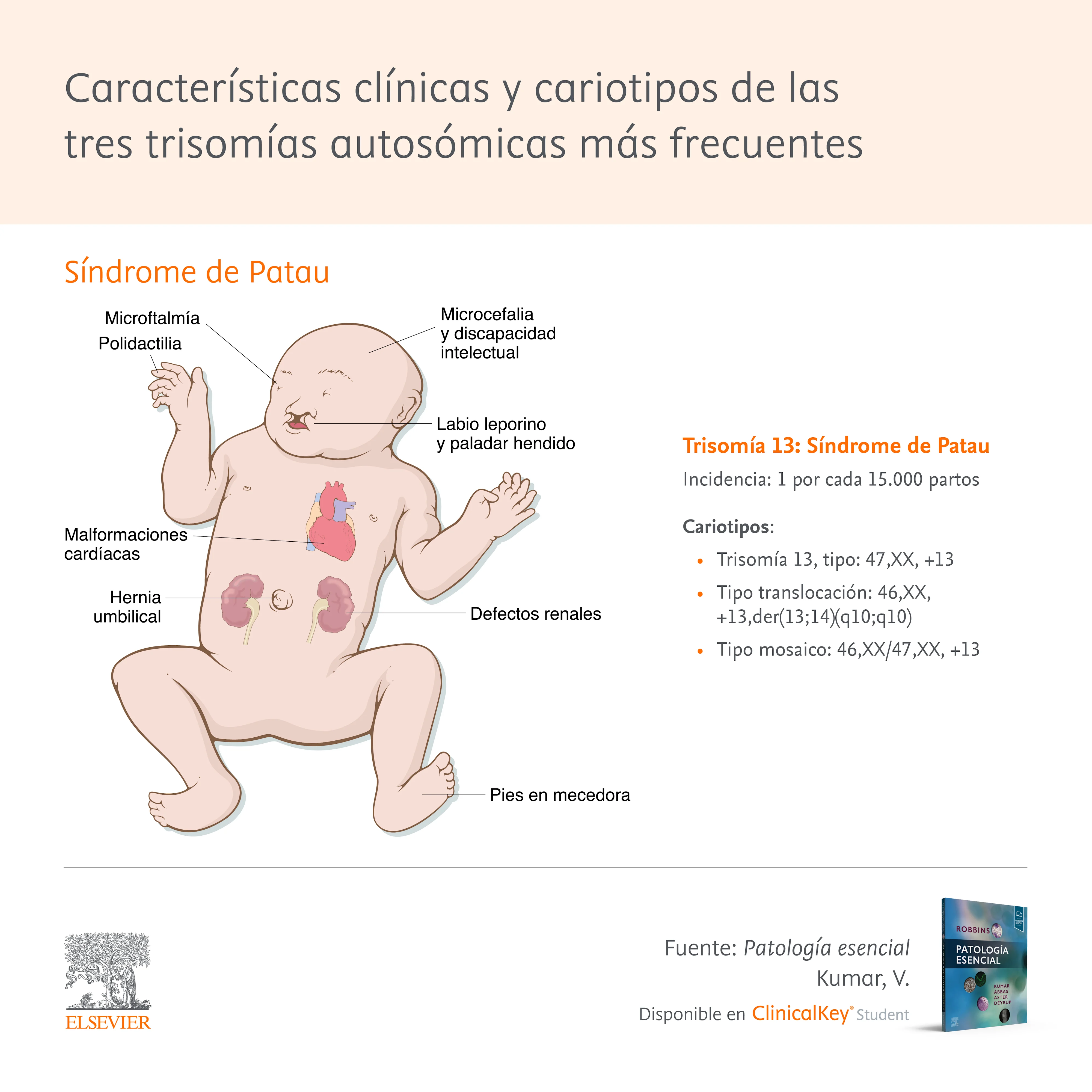 Infografia: Tres trisomías autosómicas más frecuentes
