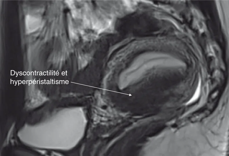 Dix-sept ans, dysménorrhée avec AS, ménorragies.  Premier T2 sagittal, coupes de 3 mm.