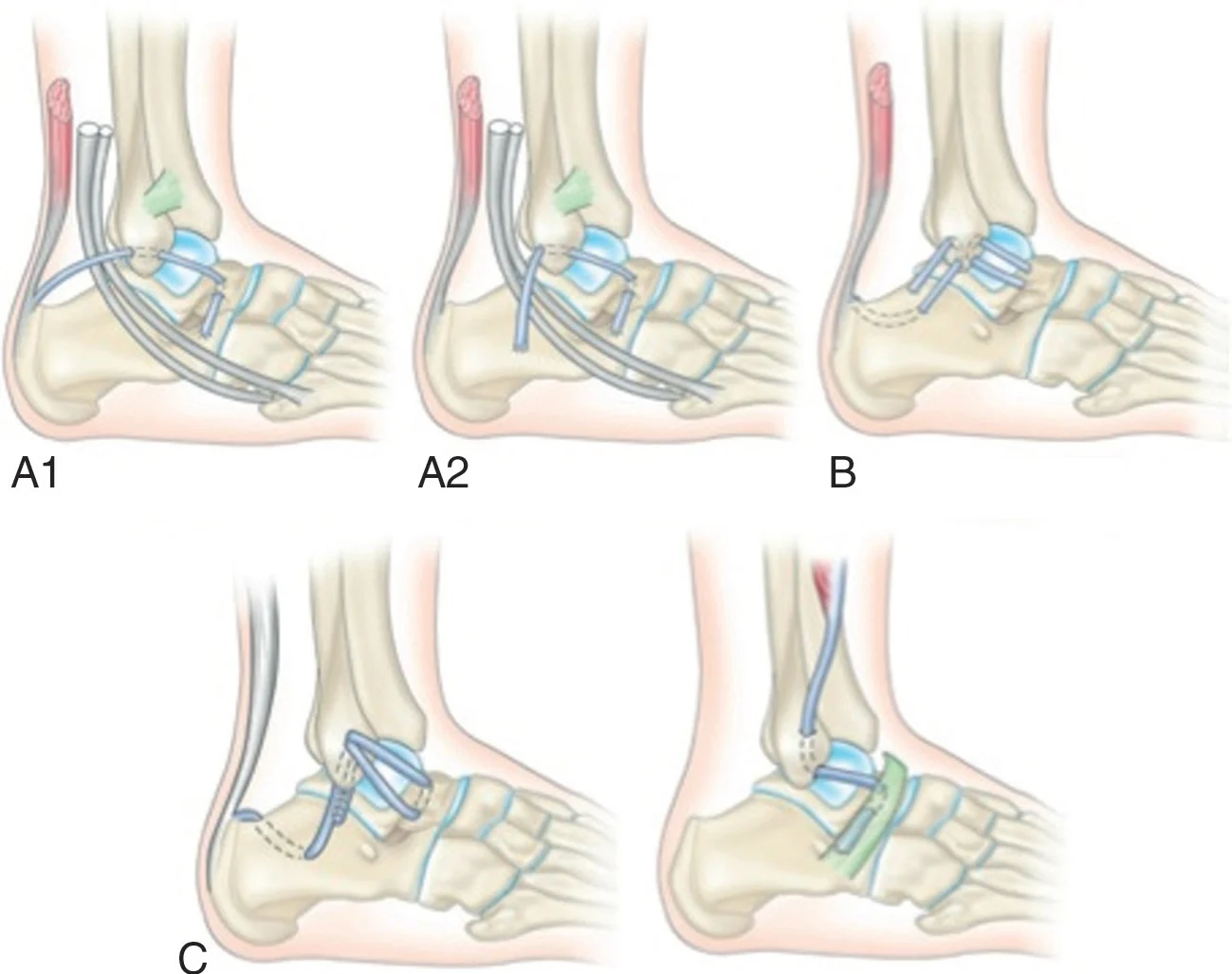 Figure 20.10 (Cliquez pour agrandir) Reconstructions anatomiques utilisant différents tendons