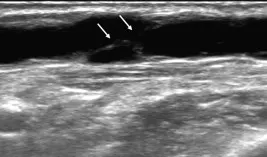 Figure 6.8. Veine céphalique à l'avant-bras avec présence de tractus fibreux endoluminaux post-thrombotiques