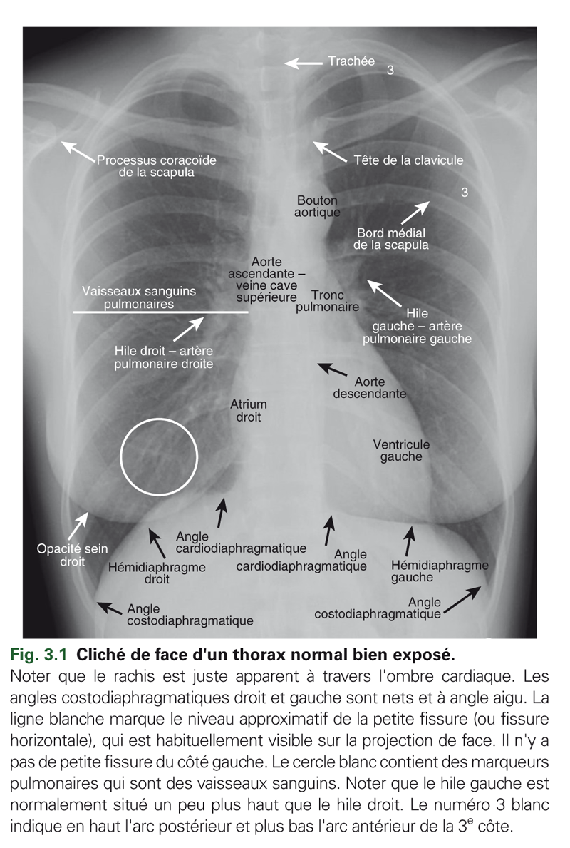 Reconnaître l'anatomie pulmonaire normale