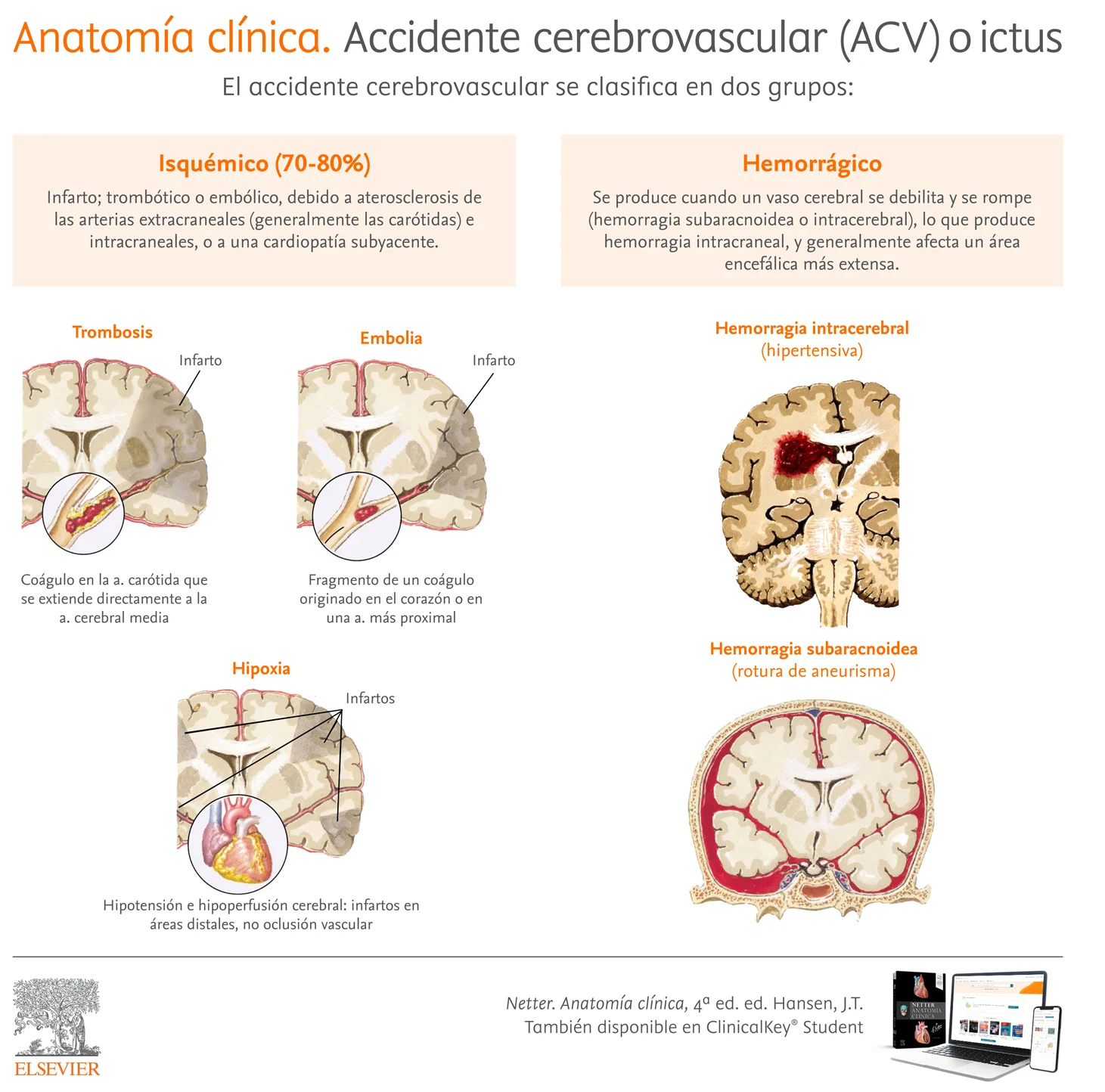 Infografia Accidente - Cerebrovascular ACV ictus
