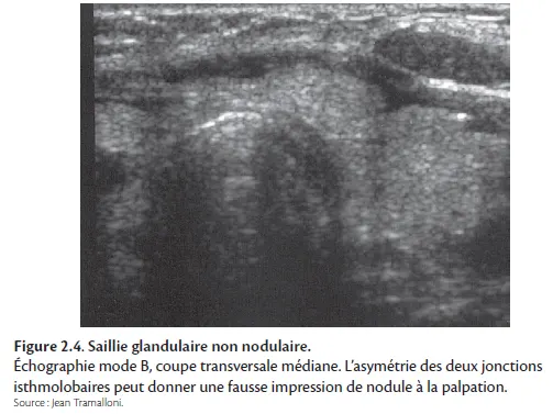 Figure 2.4 Saillie glandulaire non nodulaire