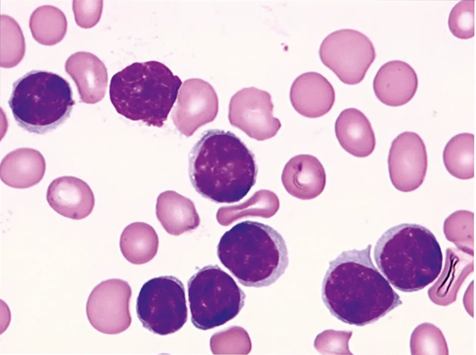 Fig. 33.1. Leucémie lymphoïde chronique
