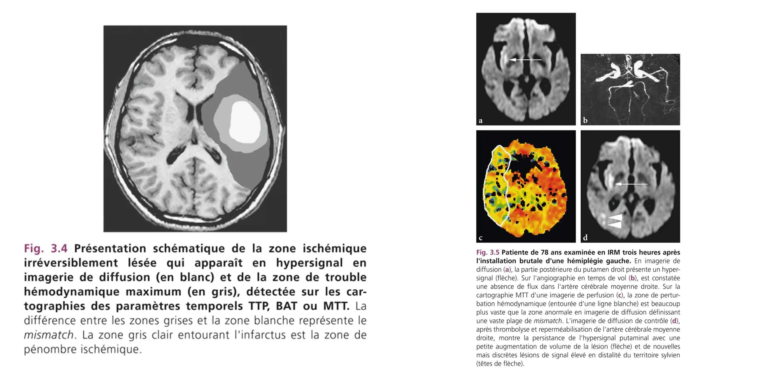 Imageries De Diffusion Et De Perfusion