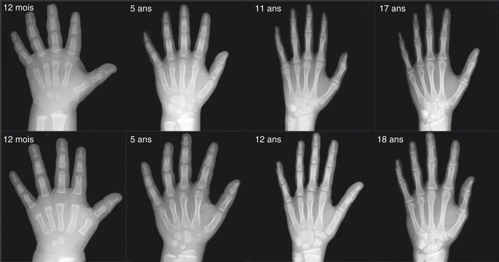 Radiographies de mains d'enfants d'âges différents