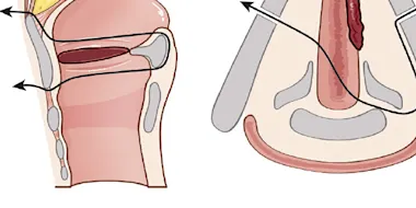 Laryngectomies partielles