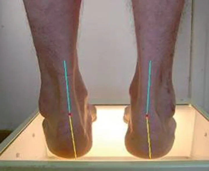 Figure 20.1 (Cliquez pour agrandir) Analyse du morphotype de l’arrière–pied en charge (varus à gauche; valgus à droite)
