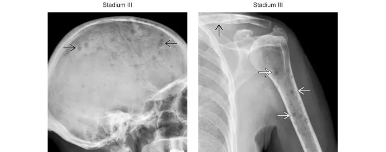 La radiographie sagittale du crâne.  La radiographie frontale de l’épaule gauche.