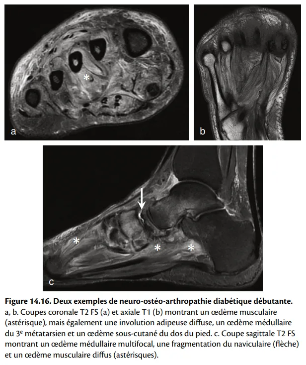 Figure 14.16: Deux exemples de neuro-ostéo-arthropathie diabétique débutante