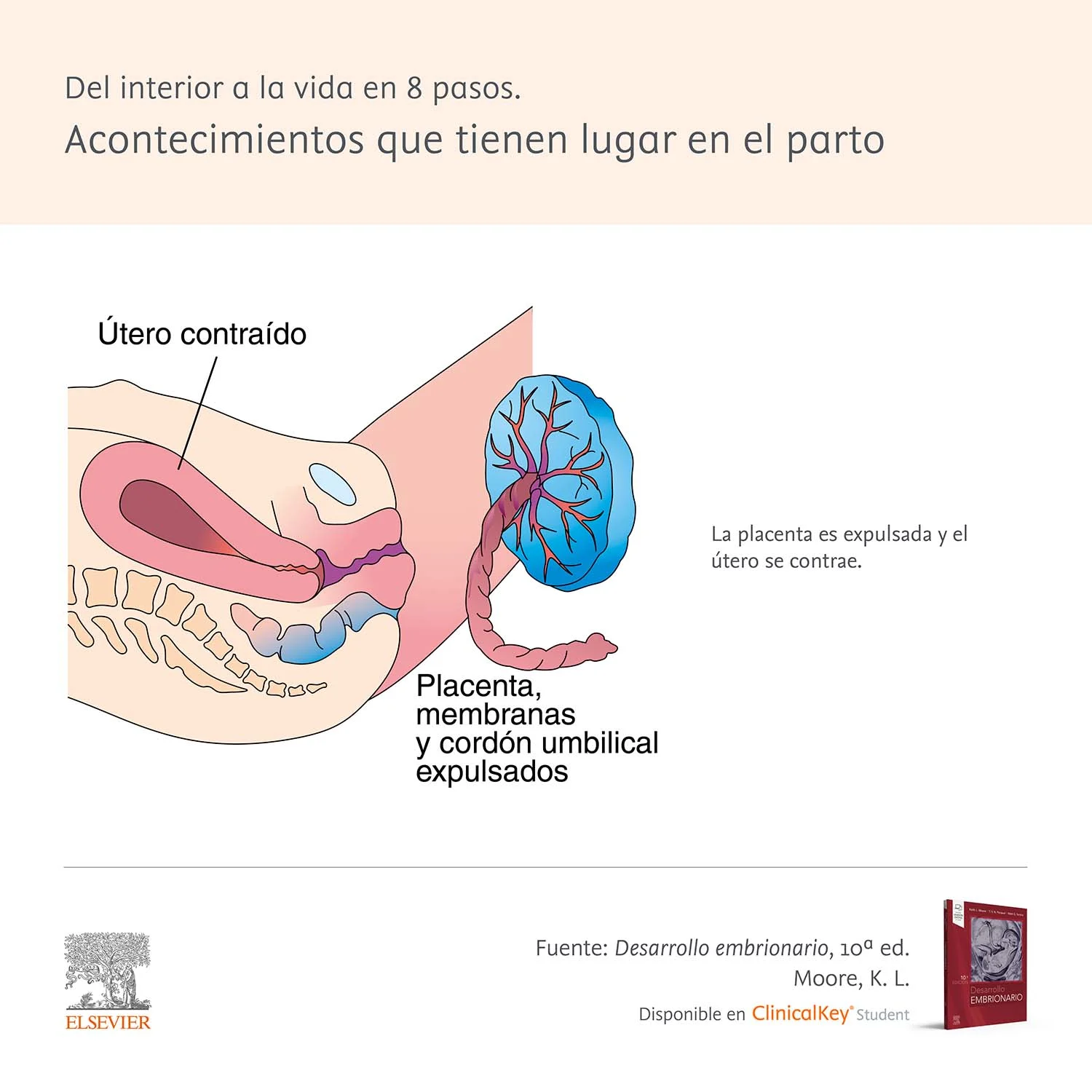 Infografia SLM Parto Moore4