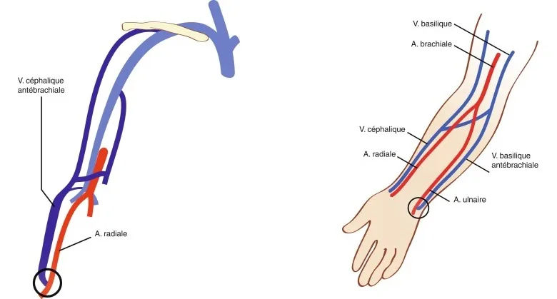 Figure 6.1. Fistule distale radio-céphalique. Figure 6.2. Fistule distale ulno-basilique.