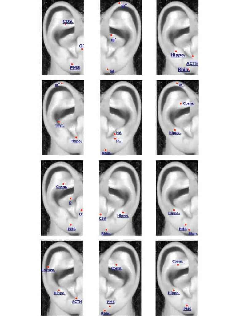 Exemples d’auriculothérapie dans le stress.