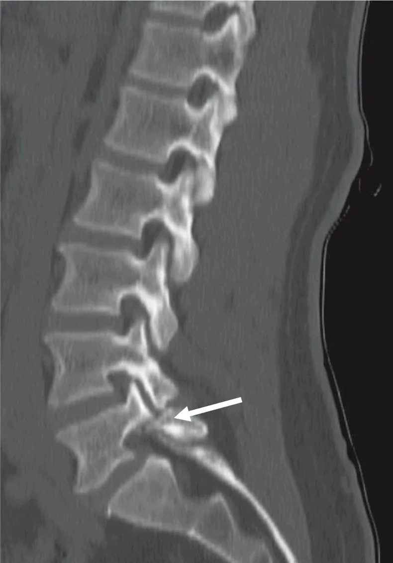 Spondylolyse sur lyse isthmique L5-S1 (flèche) avec minime spondylolisthésis de L5 de degré I.