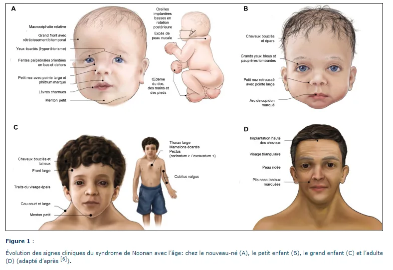 Le syndrome de Noonan