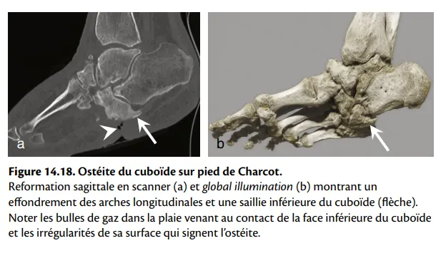 Figure 14.18: Ostéite du cuboïde sur pied de Charcot