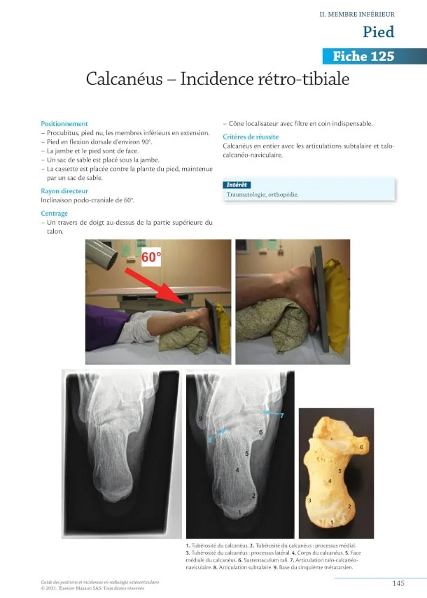 Fiche 125. Calcanéus – Incidence rétro-tibiale