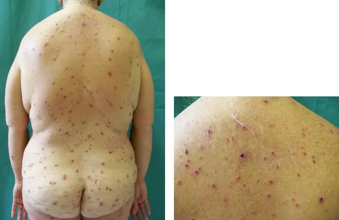 Papules croûteuses du dos et des fesses, avec des stries de grattage. Ici, il s’agit d’un aspect classique de prurigo. Lésions non spécifiques de grattage chez une patiente ayant une cholestase.